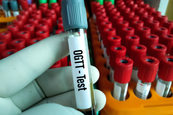 Close-up of an OGTT sample tube, representing gestational diabetes in pregnant women.