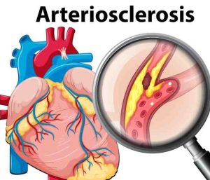 A heart model with atherosclerosis, showing how high blood sugar increases the risk of heart attacks and strokes.