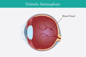 A blood vessel highlighting the eye, illustrating diabetic retinopathy, a common diabetes complication.
