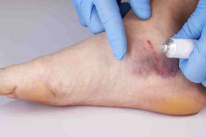 A person wearing gloves applying ointment as part of daily care to prevent diabetic foot ulcers.