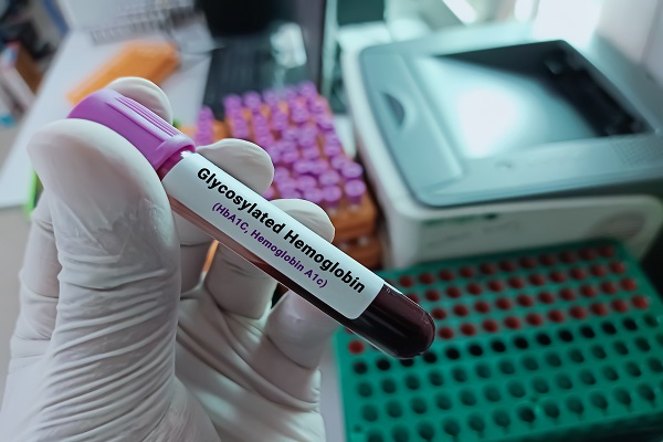 Glycosylated Hemoglobin (HbA1c) test with blood sample, showing how it helps monitor blood sugar levels over time.