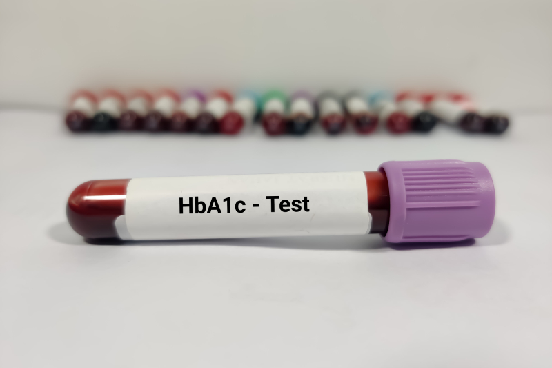 A blood sample for the HbA1C test, also known as the glycated hemoglobin test, representing a crucial diabetes screening.