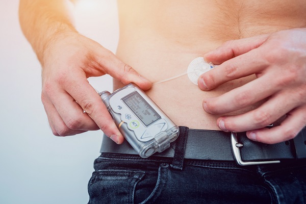 A diabetic man with an insulin pump attached to his abdomen, a type of patch pump.