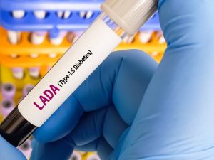 A lab technician holding a blood sample for LADA, an adult-onset autoimmune type 1.5 diabetes.