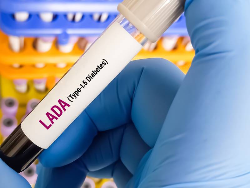 A lab technician holding a blood sample for LADA, an adult-onset autoimmune type 1.5 diabetes.