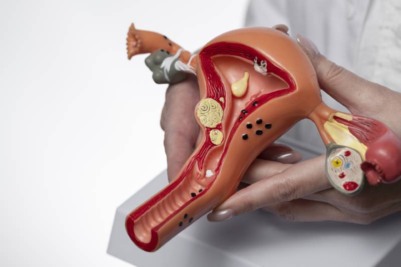Doctor explains main cause of vaginal yeast infections using ovary model.