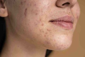 Diabetic woman with a skin allergy, illustrating how blood sugar control and skincare can help prevent or manage complications.