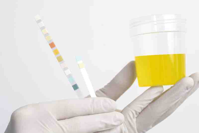 Laboratorian holding a urine test strip, showing how to check for ketones when blood sugar is high.