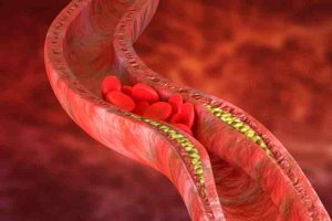 3D model of atherosclerosis showing restricted blood flow caused by a clogged artery with red blood cells.