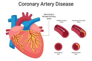 A diagram depicting blocked coronary arteries, leading to reduced blood supply to the heart muscle.