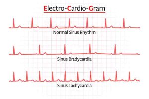 Electrocardiogram chart illustrating normal sinus rhythm, sinus bradycardia, and sinus tachycardia.