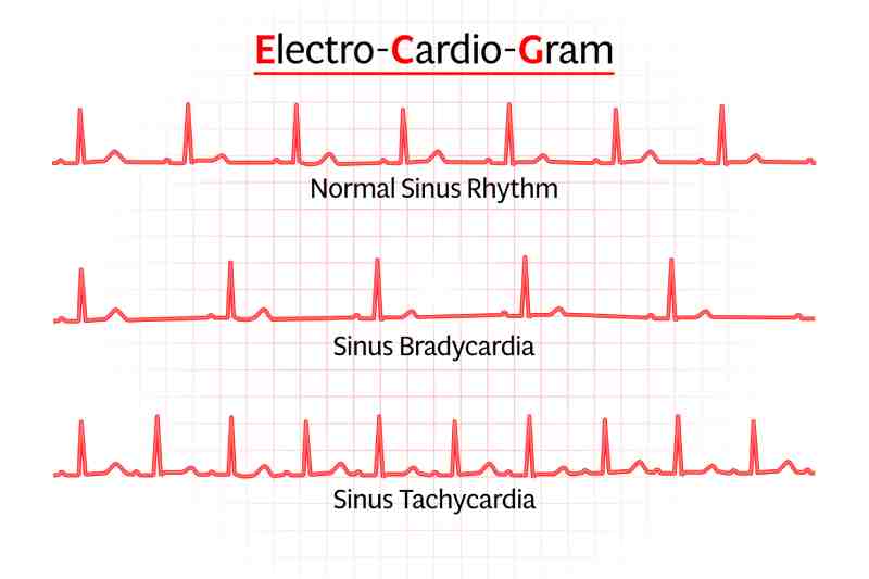 Electrocardiogram chart illustrating normal sinus rhythm, sinus bradycardia, and sinus tachycardia.