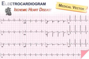 Heart monitor showing ECG changes linked to Ischemic Heart Disease.