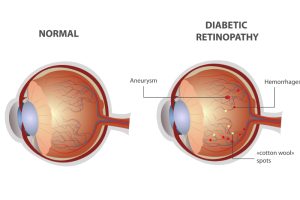 Diagram comparing a normal eye to one with diabetic retinopathy.