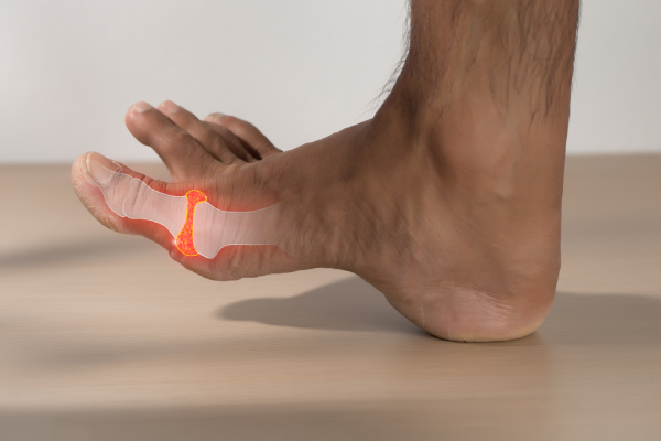 Foot showing inflamed joints due to rheumatoid arthritis, highlighting autoimmune joint pain.