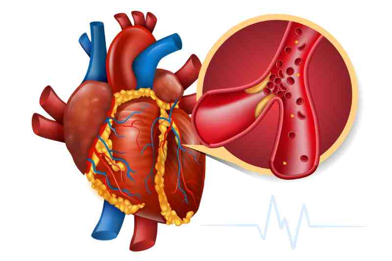 Medical illustration of the human heart with a zoomed-in view of a coronary artery blocked by plaque buildup.