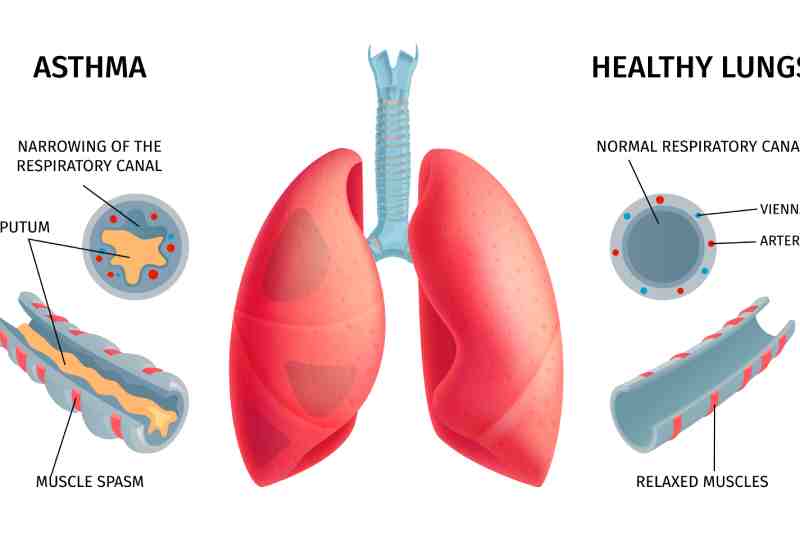 An illustration comparing the symptoms and causes of healthy lungs and asthma-affected lungs.