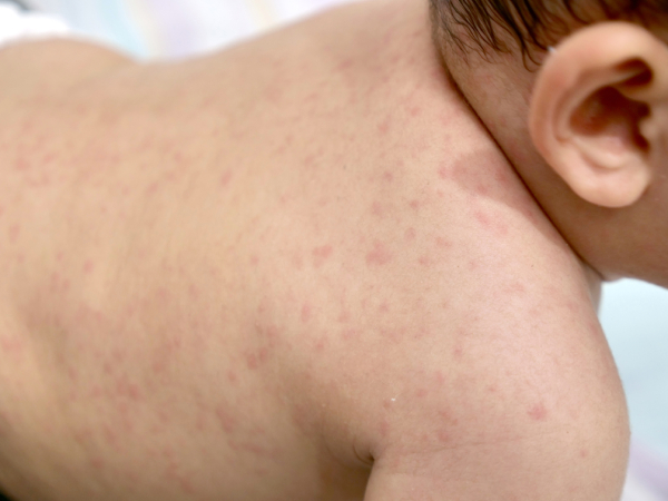 Baby’s back with visible red rash, highlighting skin symptoms that may require medical attention.