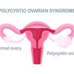 PCOS