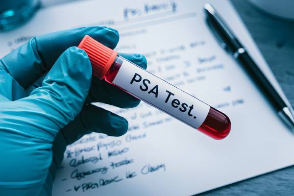Blood sample labeled "PSA Test," representing prostate health screening and diagnosis.