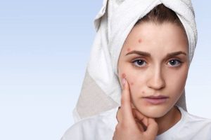 A woman with a few pimples on her face, representing common causes of acne.