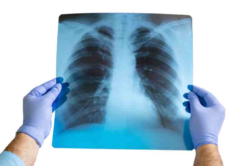 A doctor holding a lung X-ray film for examining tuberculosis.