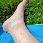 Snake Bite